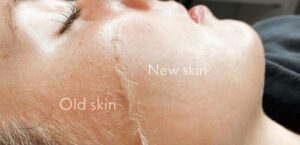 The Benefits of Dermaplaning | Glamor Medical